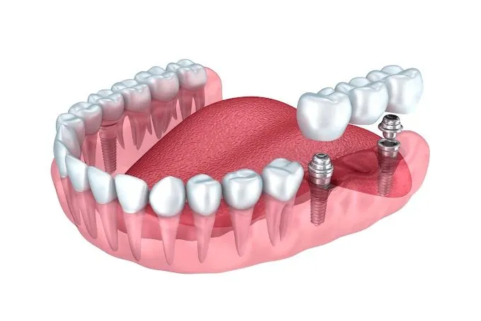 Root Canal Treatment in Trivandrum