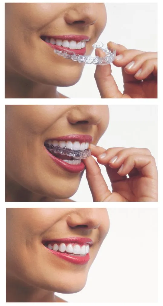 Invisalign clinic in Trivandrum