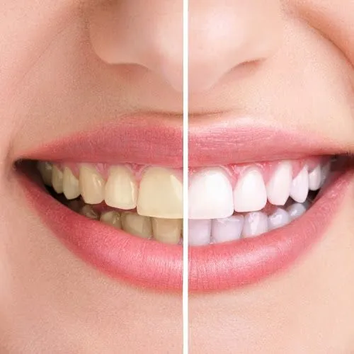 Teeth cleaning in Trivandrum