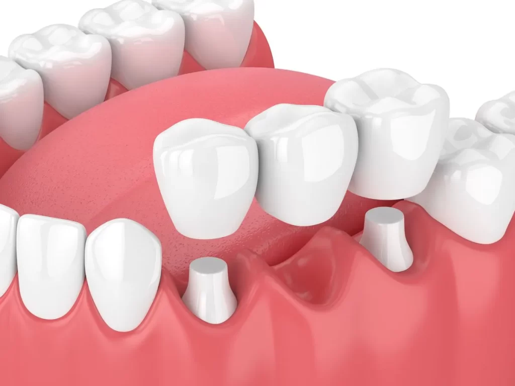 Root canal treatment in Trivandrum