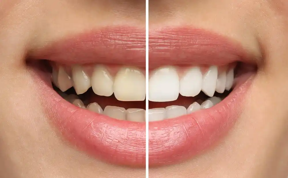 Teeth Whitening Services in Trivandrum