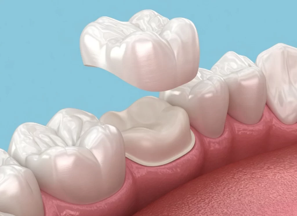 Dental Bridges and Crowns in Trivandrum