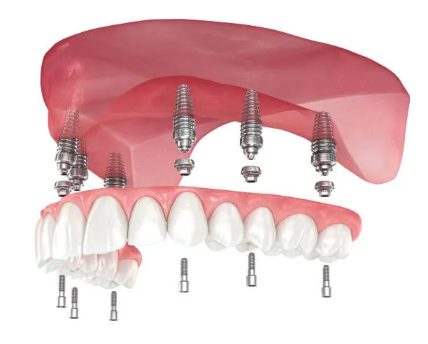 Orthodontic Treatment in Trivandrum
