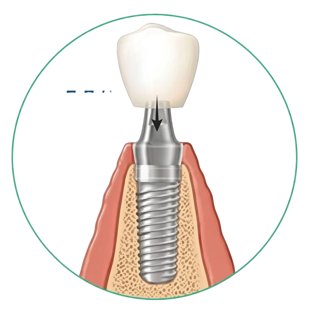 Dental implants in Trivandrum