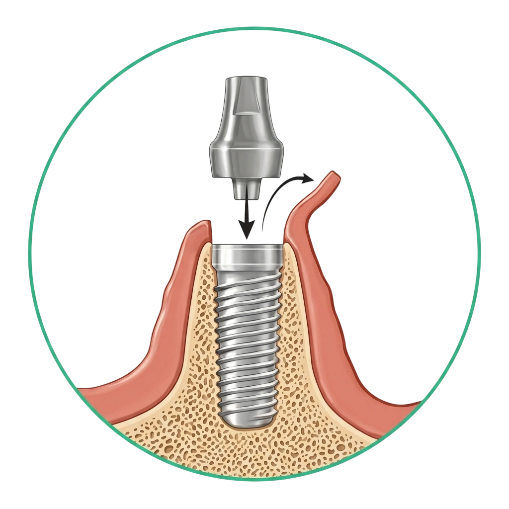 Dental implants in Trivandrum