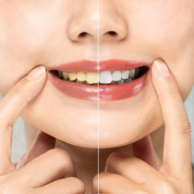 Teeth whitening services in Trivandrum