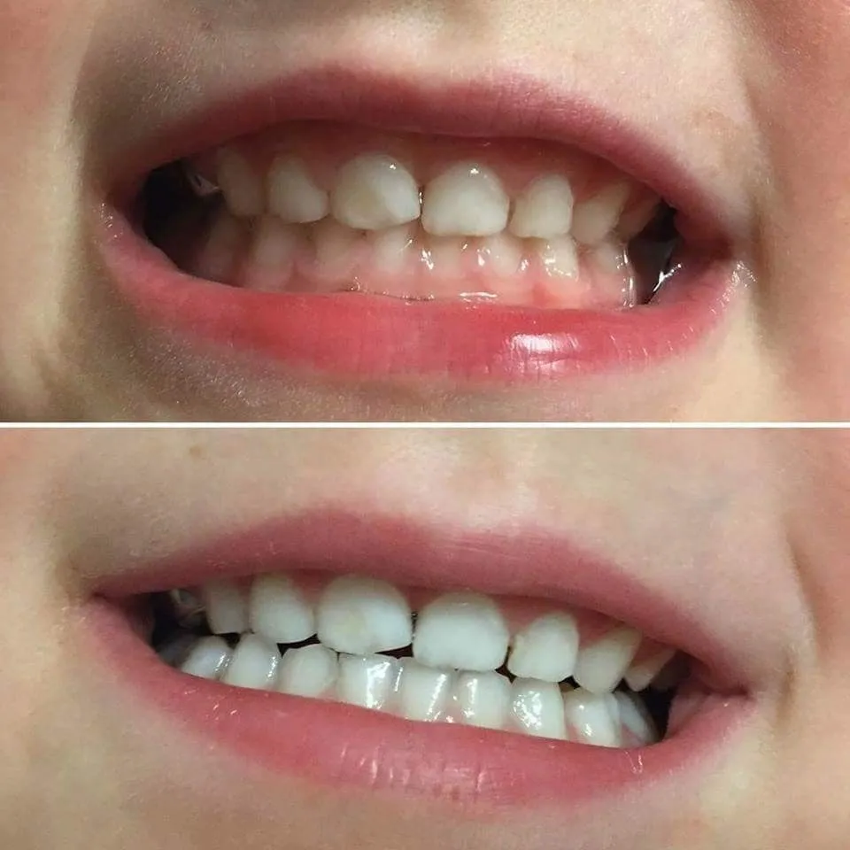 Teeth cleaning in Trivandrum