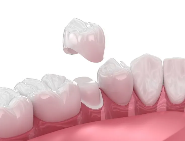 Root canal treatment in Trivandrum
