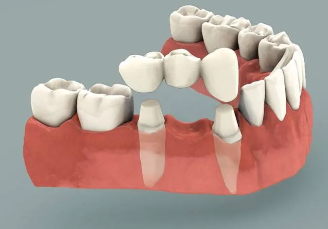 Dental Bridges and Crowns in Trivandrum