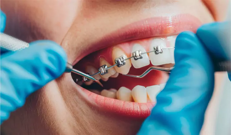Best braces clinic in TrivandrumTrivandrum