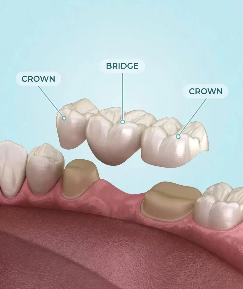 Dental Bridges and Crowns in Trivandrum