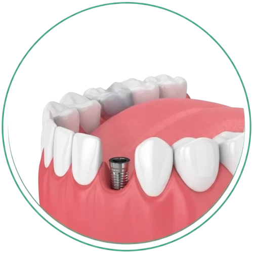 Dental implants in Trivandrum