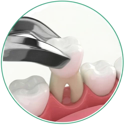 Dental Bridges and Crowns in Trivandrum